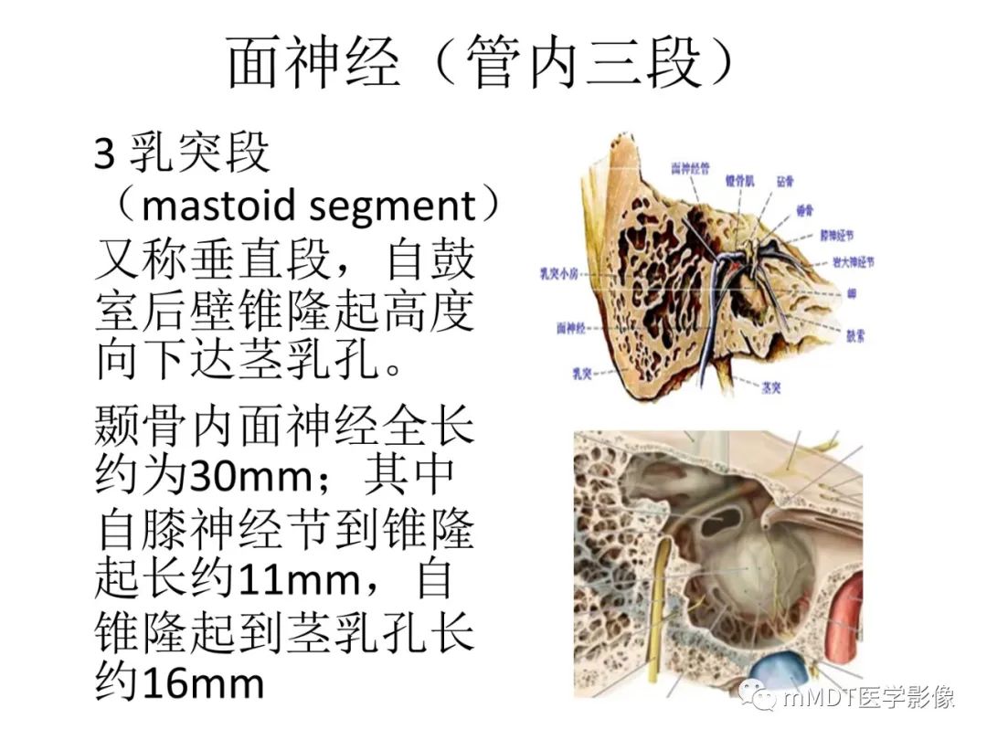 影像PPT - 【病例】岩洞深处藏神仙—穿行在颞骨岩部的神经们-47