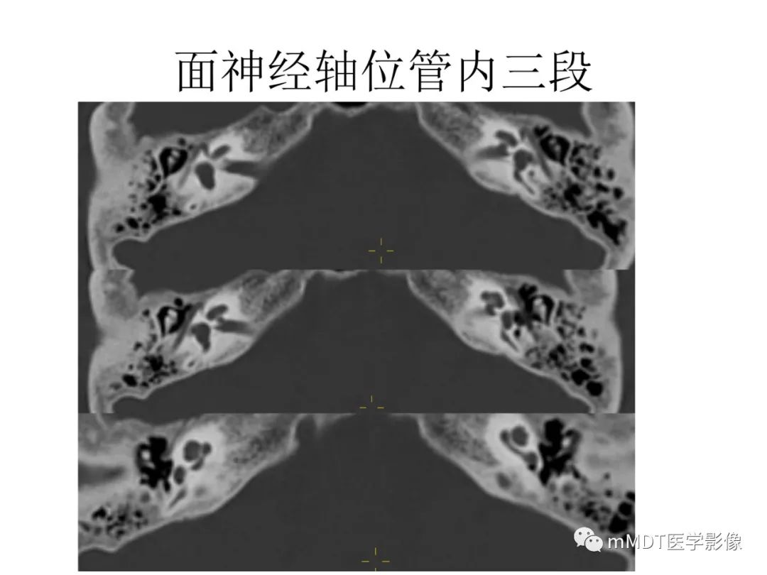 影像PPT - 【病例】岩洞深处藏神仙—穿行在颞骨岩部的神经们-48
