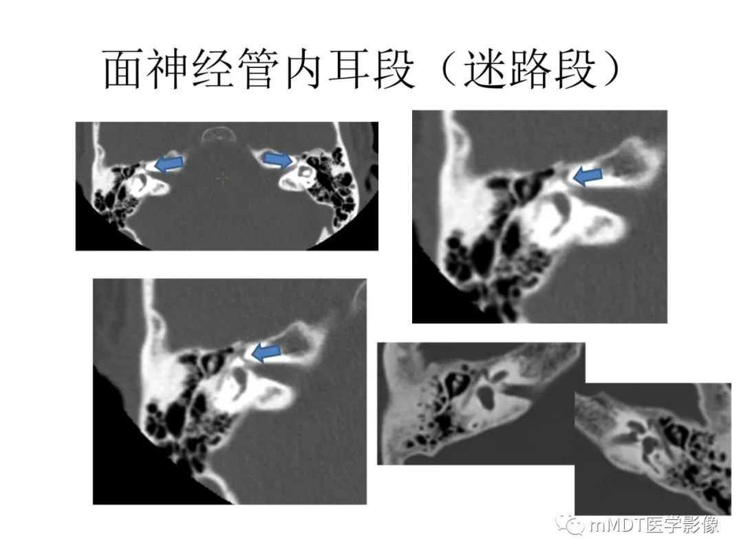 影像PPT - 【病例】岩洞深处藏神仙—穿行在颞骨岩部的神经们-49
