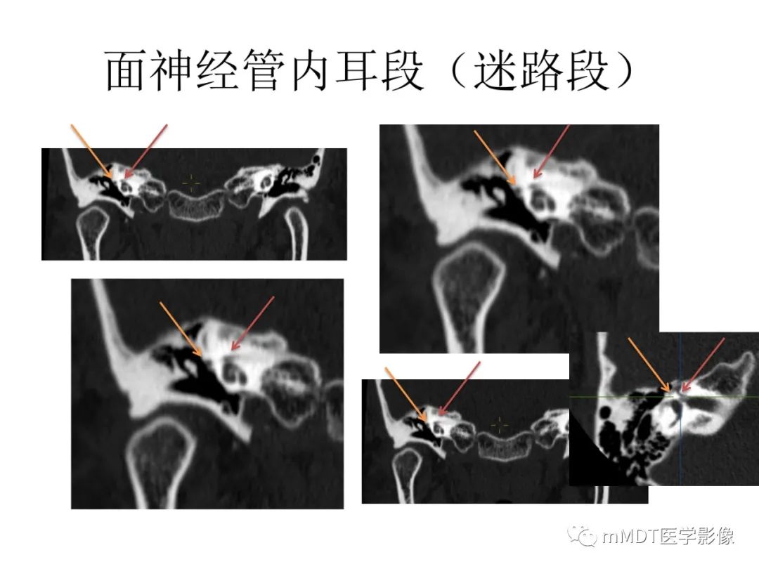 影像PPT - 【病例】岩洞深处藏神仙—穿行在颞骨岩部的神经们-51