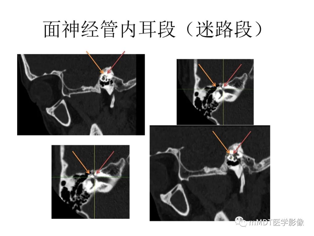 影像PPT - 【病例】岩洞深处藏神仙—穿行在颞骨岩部的神经们-52