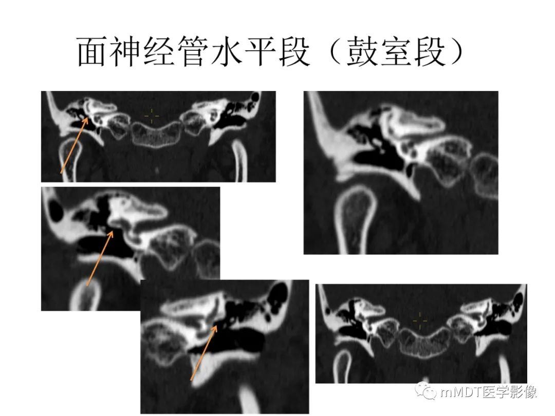 影像PPT - 【病例】岩洞深处藏神仙—穿行在颞骨岩部的神经们-55