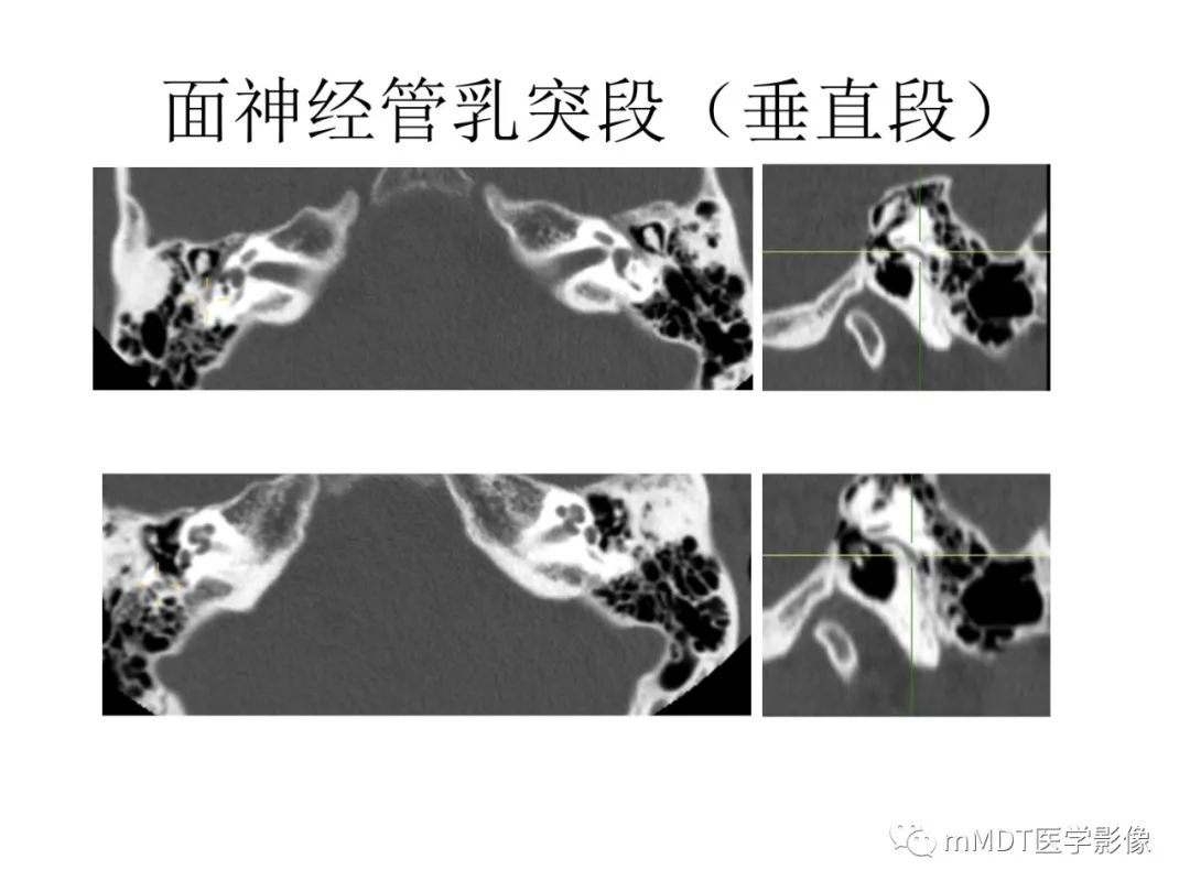 影像PPT - 【病例】岩洞深处藏神仙—穿行在颞骨岩部的神经们-59