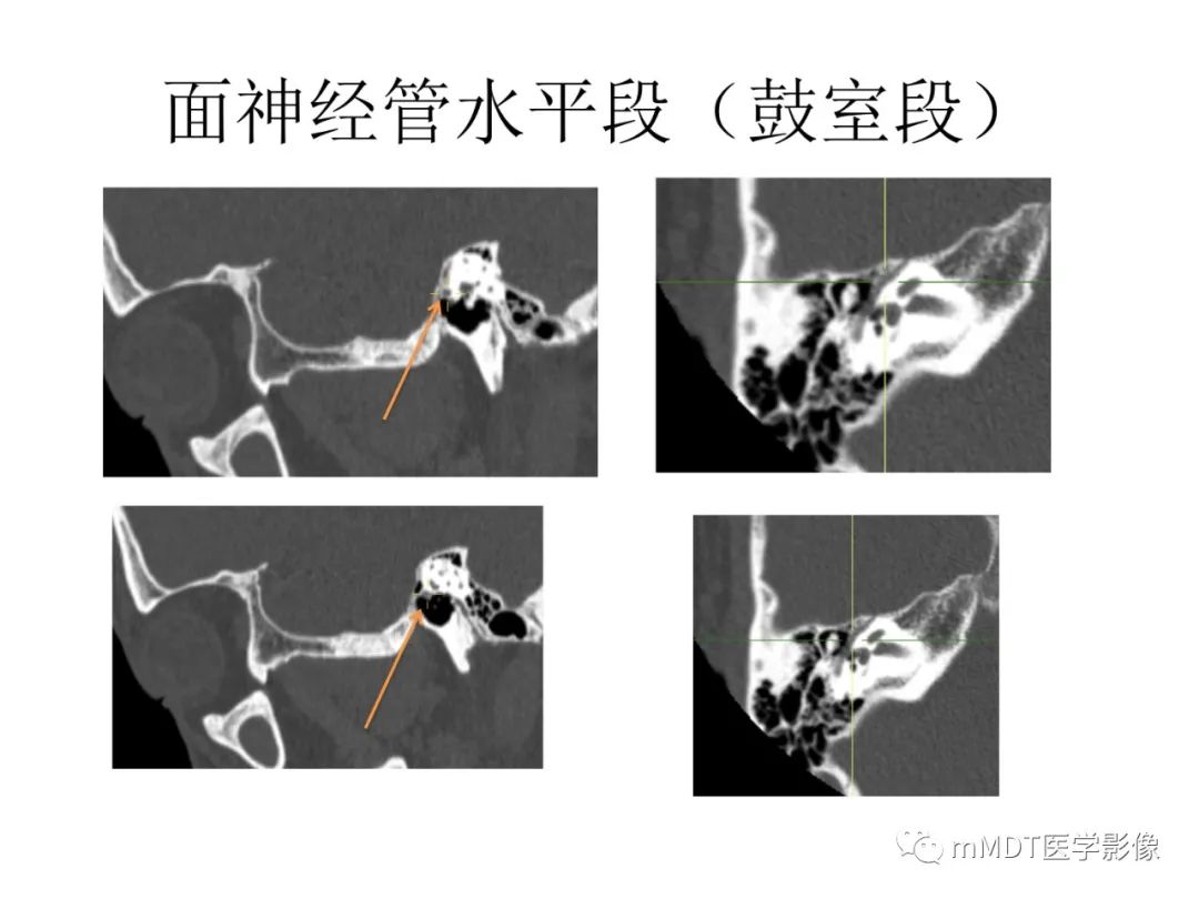 影像PPT - 【病例】岩洞深处藏神仙—穿行在颞骨岩部的神经们-57