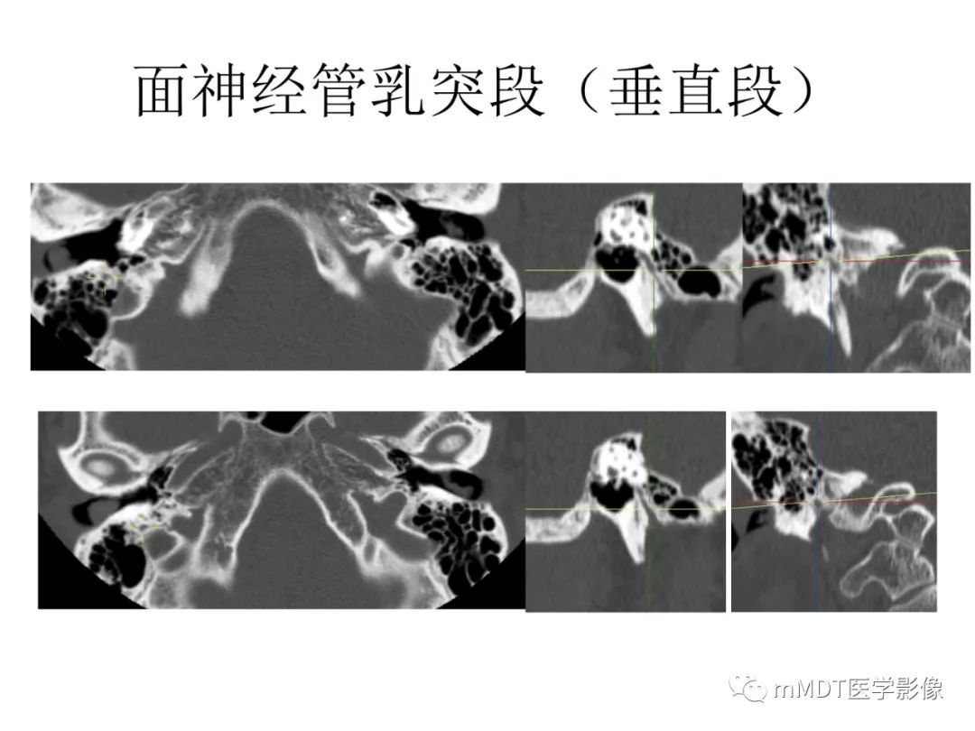 影像PPT - 【病例】岩洞深处藏神仙—穿行在颞骨岩部的神经们-60