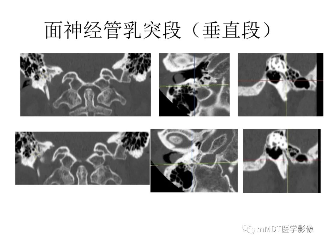 影像PPT - 【病例】岩洞深处藏神仙—穿行在颞骨岩部的神经们-62
