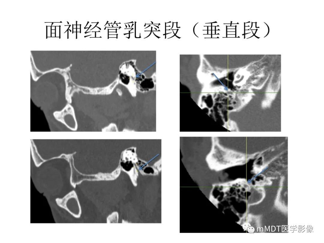 影像PPT - 【病例】岩洞深处藏神仙—穿行在颞骨岩部的神经们-65