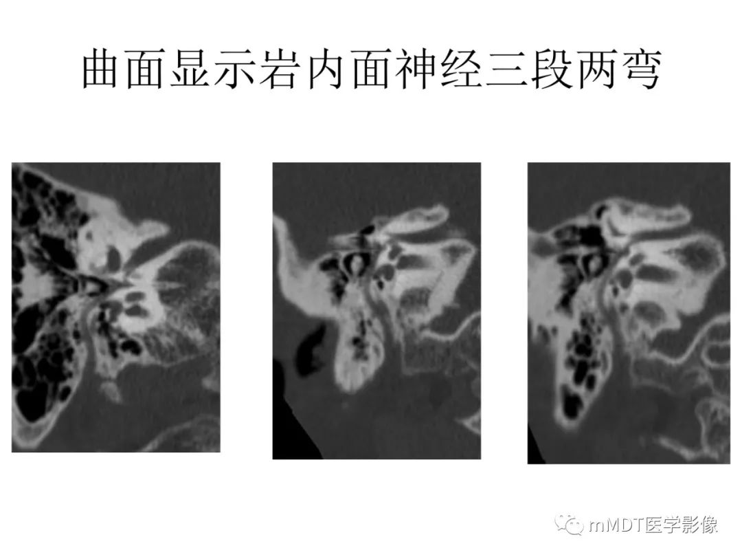 影像PPT - 【病例】岩洞深处藏神仙—穿行在颞骨岩部的神经们-67