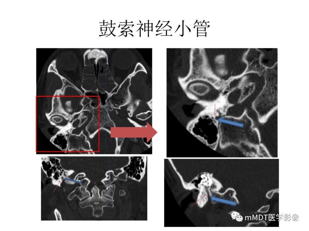 影像PPT - 【病例】岩洞深处藏神仙—穿行在颞骨岩部的神经们-68