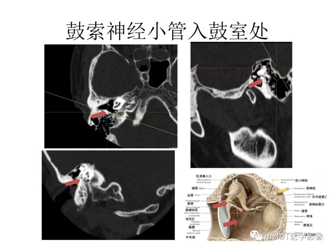 影像PPT - 【病例】岩洞深处藏神仙—穿行在颞骨岩部的神经们-71