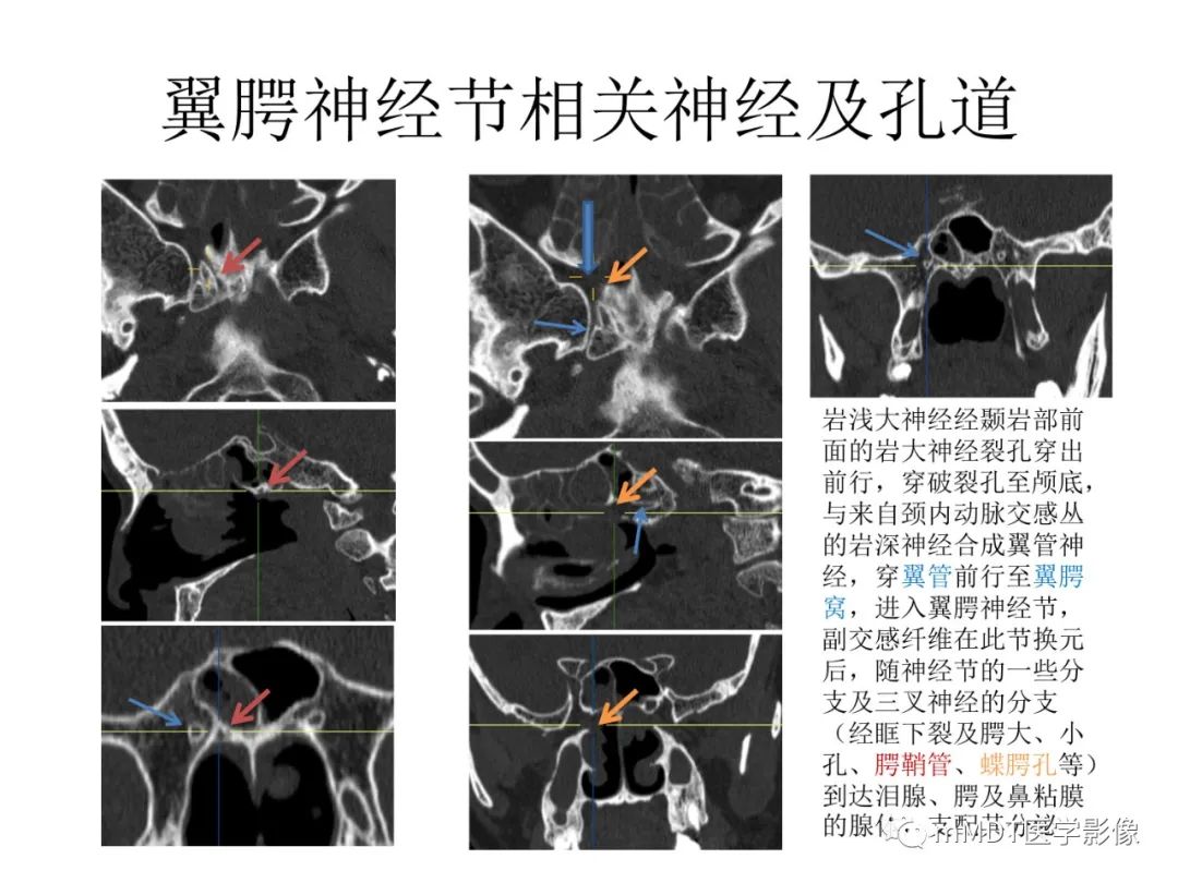 影像PPT - 【病例】岩洞深处藏神仙—穿行在颞骨岩部的神经们-76