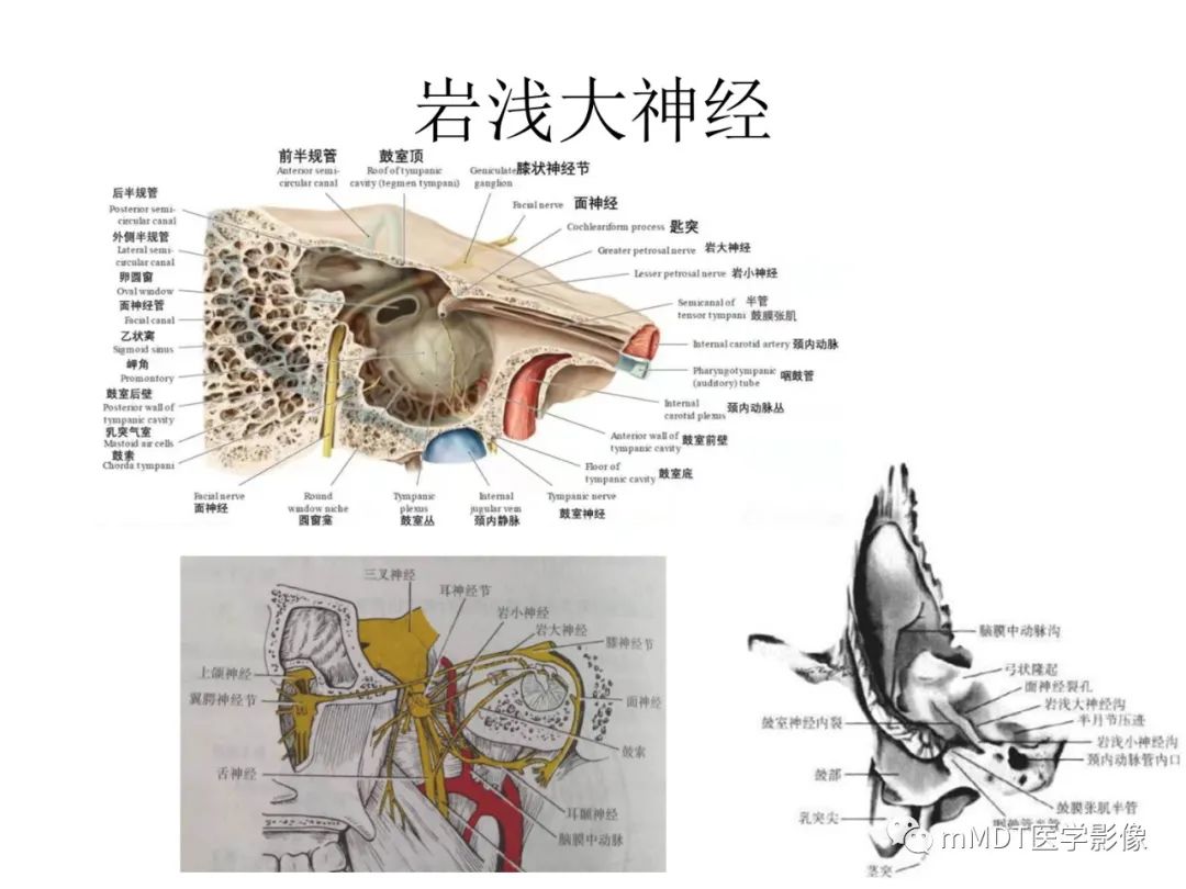 影像PPT - 【病例】岩洞深处藏神仙—穿行在颞骨岩部的神经们-74