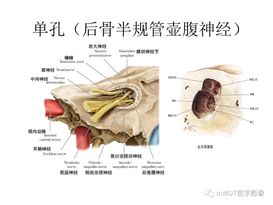 影像PPT - 【病例】岩洞深处藏神仙—穿行在颞骨岩部的神经们-79
