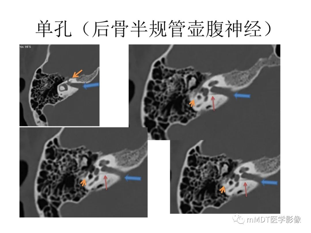 影像PPT - 【病例】岩洞深处藏神仙—穿行在颞骨岩部的神经们-80