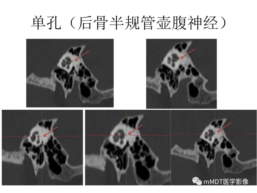 影像PPT - 【病例】岩洞深处藏神仙—穿行在颞骨岩部的神经们-82