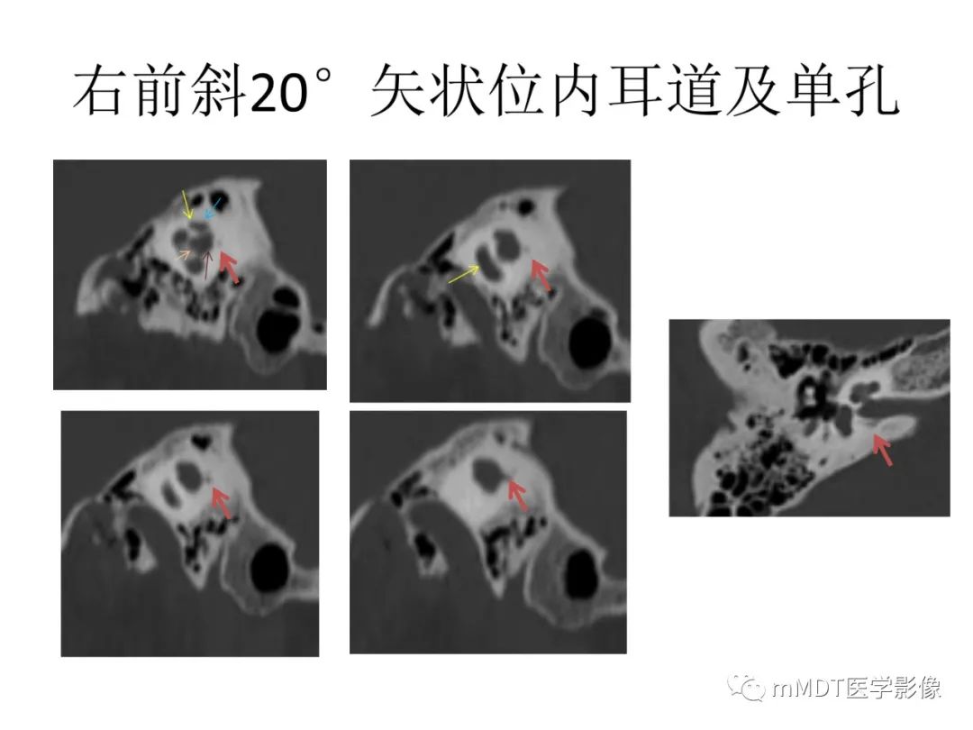 影像PPT - 【病例】岩洞深处藏神仙—穿行在颞骨岩部的神经们-83