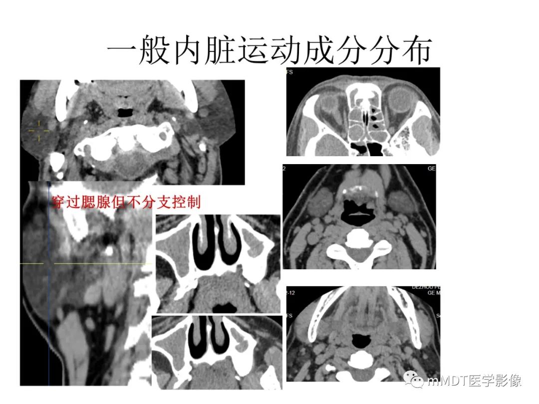 影像PPT - 【病例】岩洞深处藏神仙—穿行在颞骨岩部的神经们-78