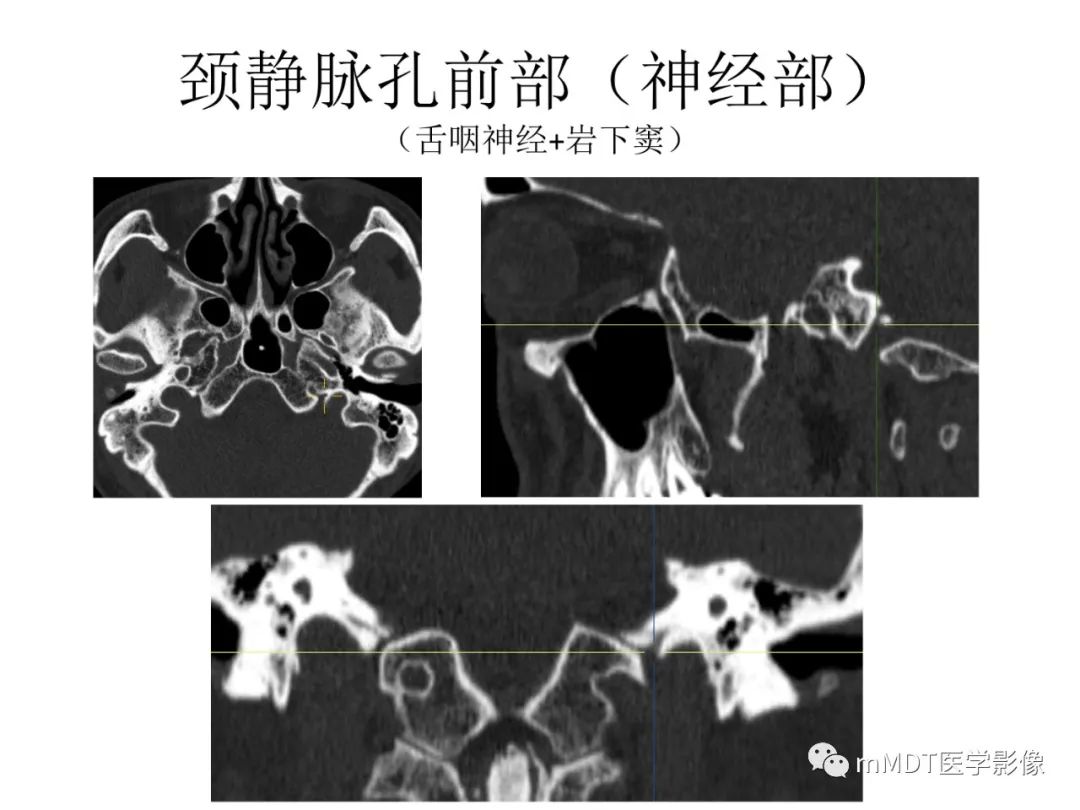 影像PPT - 【病例】岩洞深处藏神仙—穿行在颞骨岩部的神经们-85