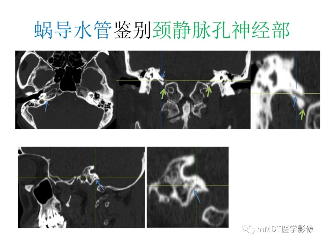 影像PPT - 【病例】岩洞深处藏神仙—穿行在颞骨岩部的神经们-87