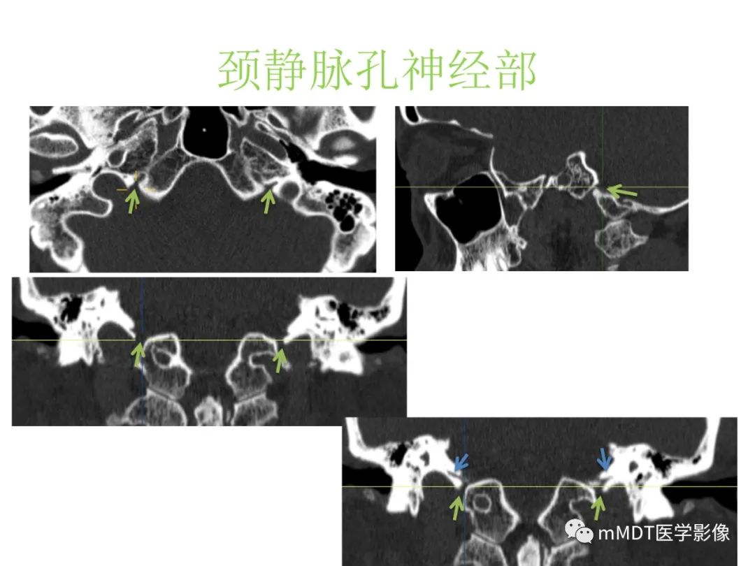 影像PPT - 【病例】岩洞深处藏神仙—穿行在颞骨岩部的神经们-88