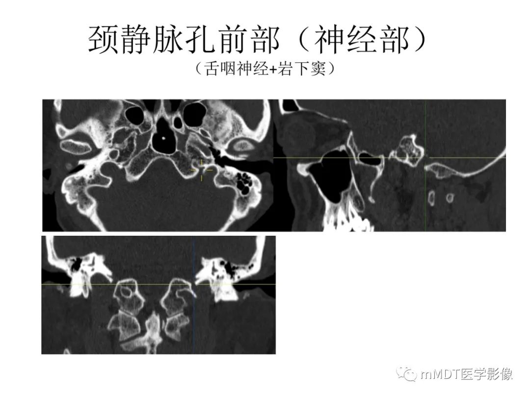影像PPT - 【病例】岩洞深处藏神仙—穿行在颞骨岩部的神经们-84