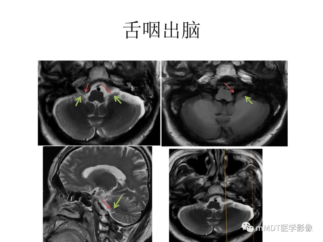 影像PPT - 【病例】岩洞深处藏神仙—穿行在颞骨岩部的神经们-89