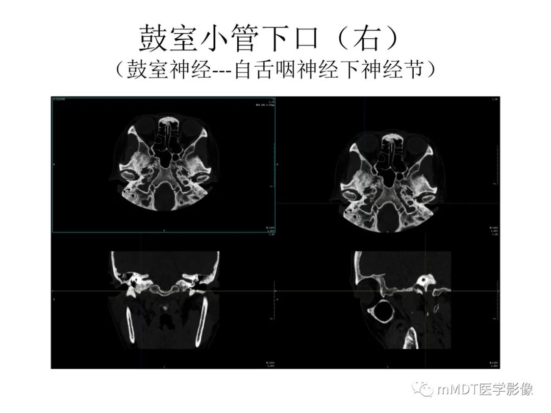 影像PPT - 【病例】岩洞深处藏神仙—穿行在颞骨岩部的神经们-90