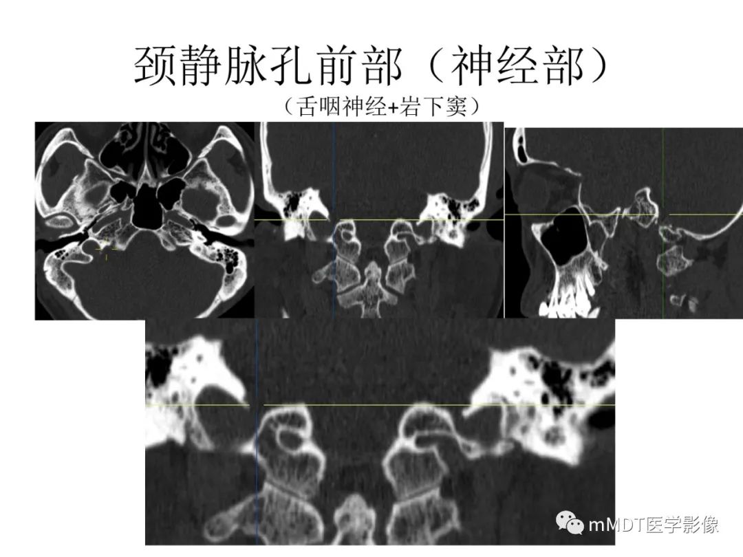 影像PPT - 【病例】岩洞深处藏神仙—穿行在颞骨岩部的神经们-86