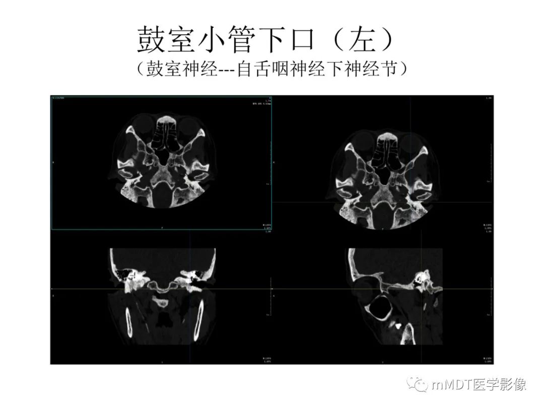 影像PPT - 【病例】岩洞深处藏神仙—穿行在颞骨岩部的神经们-91