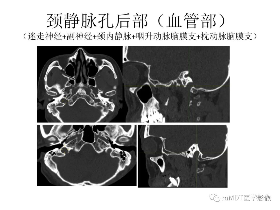 影像PPT - 【病例】岩洞深处藏神仙—穿行在颞骨岩部的神经们-92