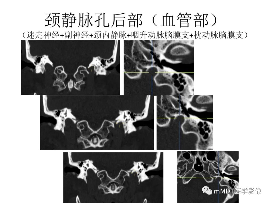 影像PPT - 【病例】岩洞深处藏神仙—穿行在颞骨岩部的神经们-93