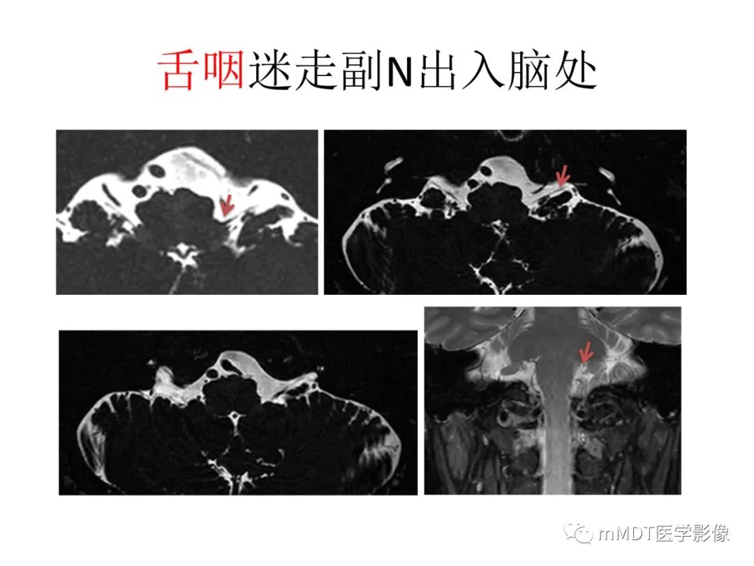 影像PPT - 【病例】岩洞深处藏神仙—穿行在颞骨岩部的神经们-94