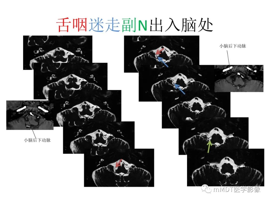 影像PPT - 【病例】岩洞深处藏神仙—穿行在颞骨岩部的神经们-96