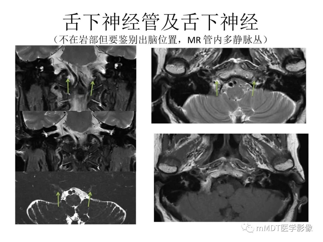 影像PPT - 【病例】岩洞深处藏神仙—穿行在颞骨岩部的神经们-97
