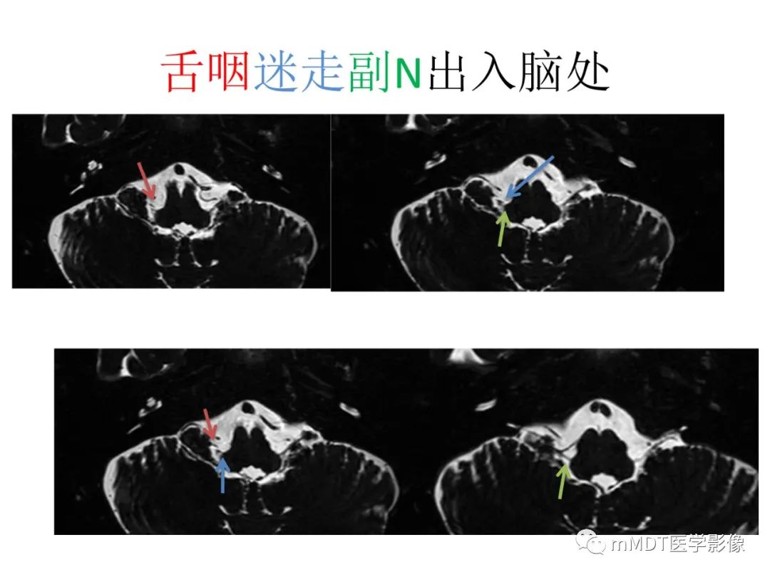 影像PPT - 【病例】岩洞深处藏神仙—穿行在颞骨岩部的神经们-95