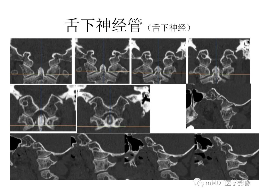 影像PPT - 【病例】岩洞深处藏神仙—穿行在颞骨岩部的神经们-100