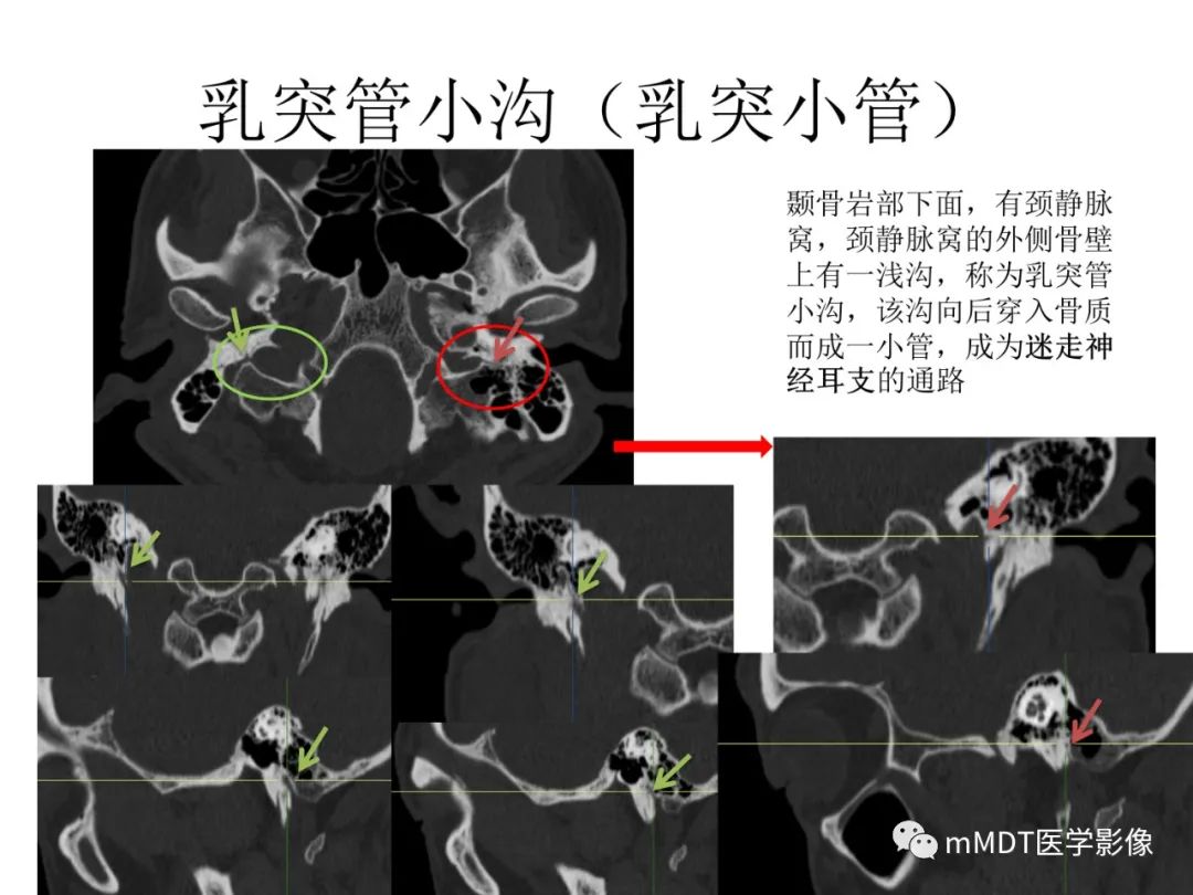 影像PPT - 【病例】岩洞深处藏神仙—穿行在颞骨岩部的神经们-101