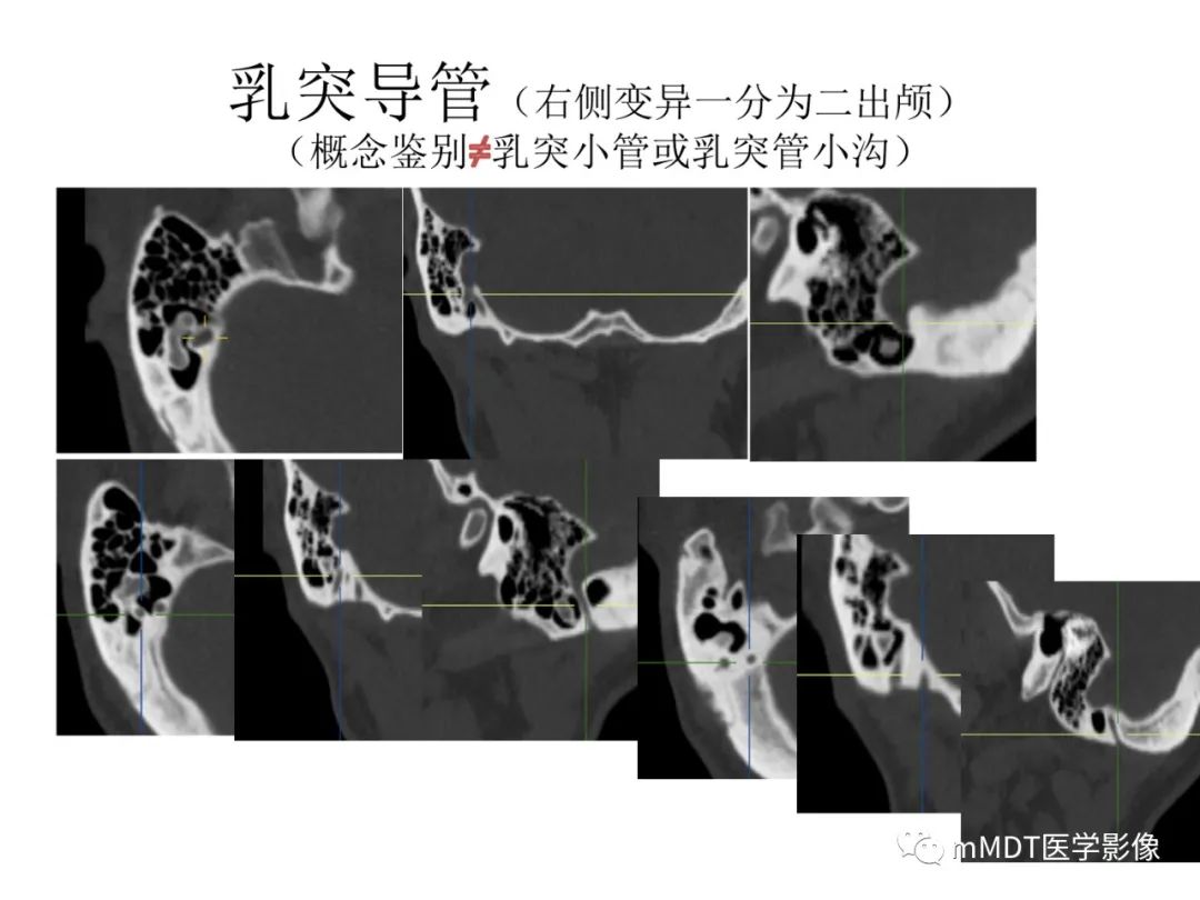 影像PPT - 【病例】岩洞深处藏神仙—穿行在颞骨岩部的神经们-105