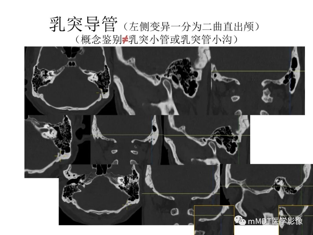 影像PPT - 【病例】岩洞深处藏神仙—穿行在颞骨岩部的神经们-106