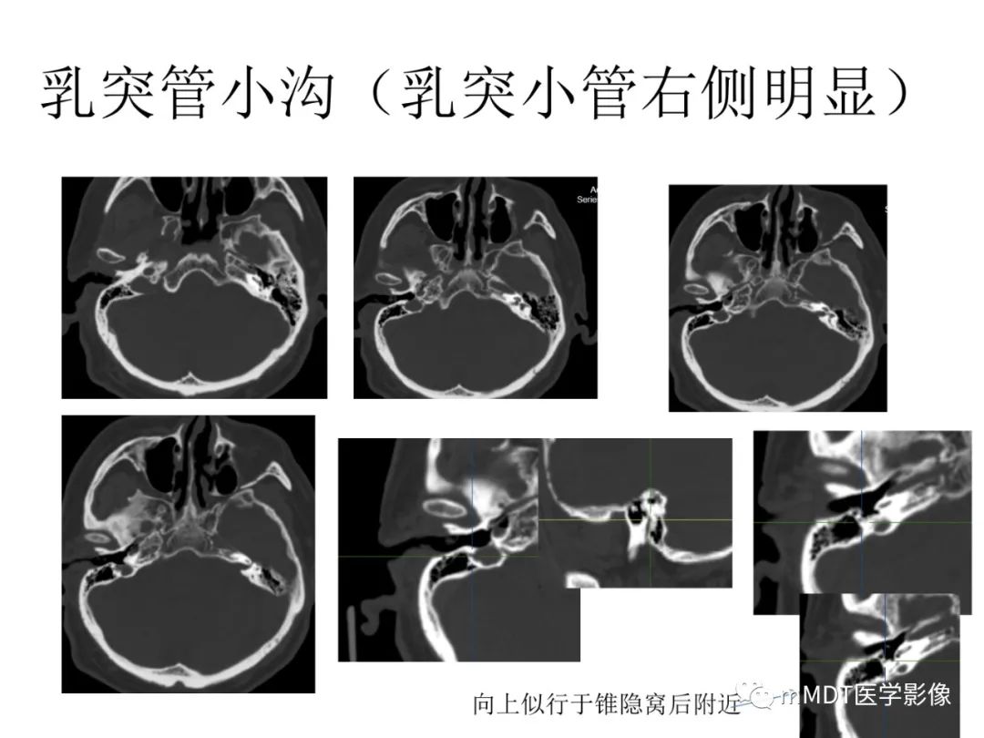 影像PPT - 【病例】岩洞深处藏神仙—穿行在颞骨岩部的神经们-102