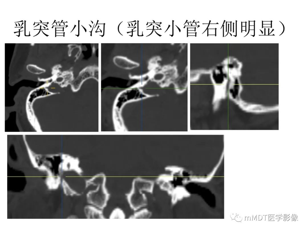 影像PPT - 【病例】岩洞深处藏神仙—穿行在颞骨岩部的神经们-103