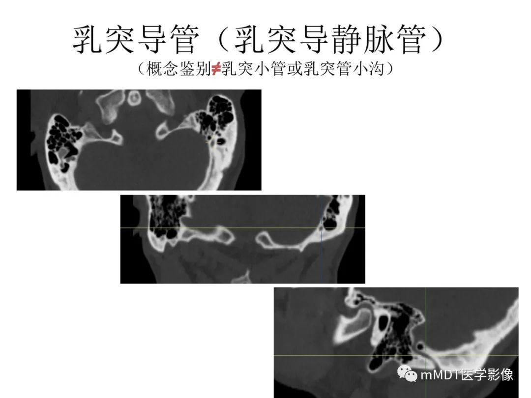 影像PPT - 【病例】岩洞深处藏神仙—穿行在颞骨岩部的神经们-104