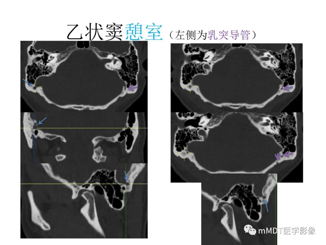 影像PPT - 【病例】岩洞深处藏神仙—穿行在颞骨岩部的神经们-107
