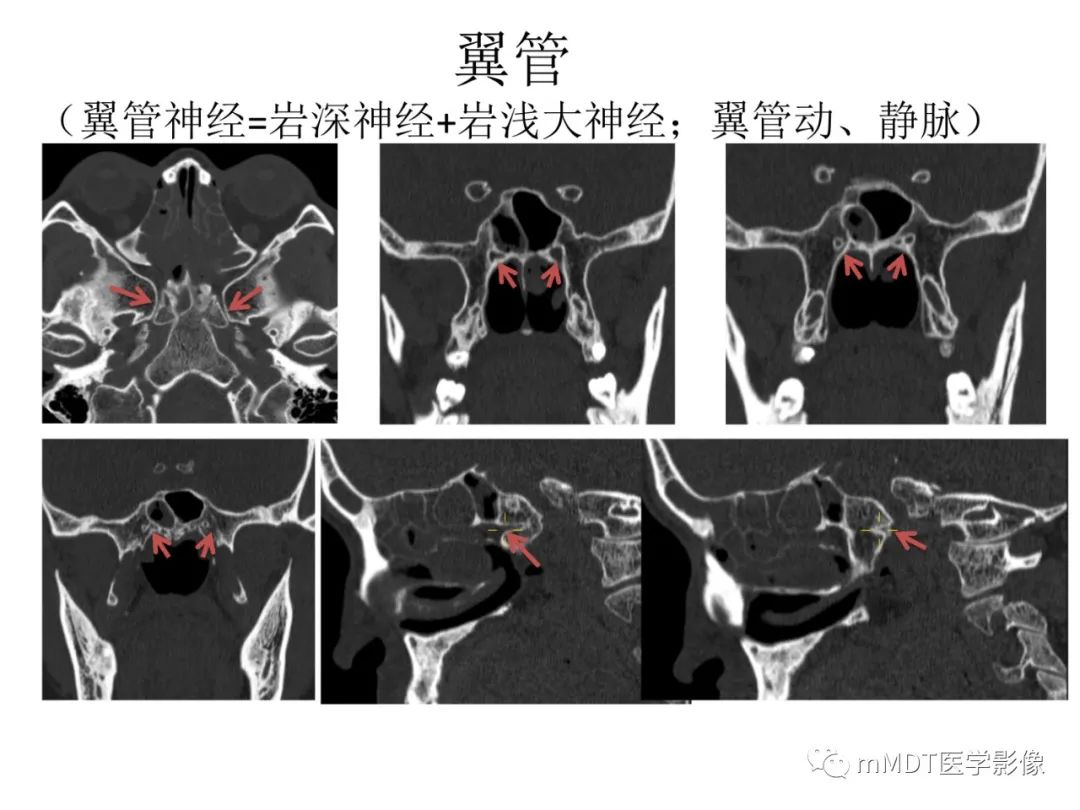 影像PPT - 【病例】岩洞深处藏神仙—穿行在颞骨岩部的神经们-112