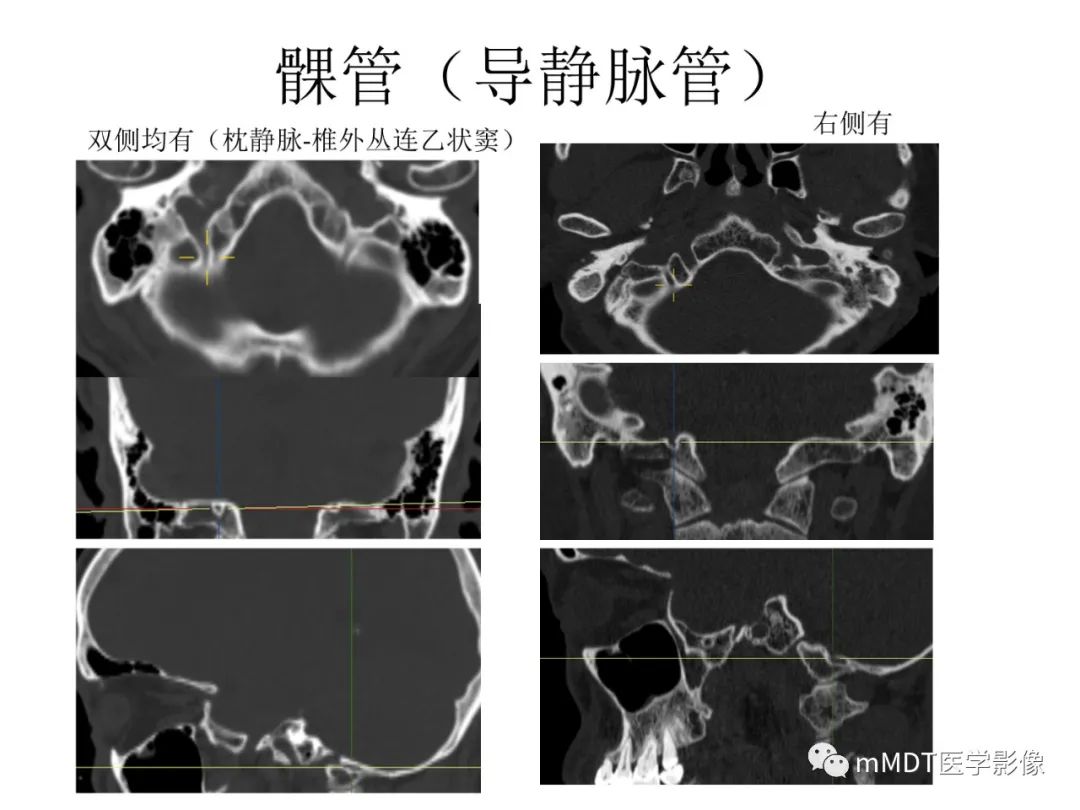 影像PPT - 【病例】岩洞深处藏神仙—穿行在颞骨岩部的神经们-108