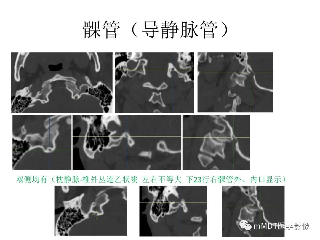 影像PPT - 【病例】岩洞深处藏神仙—穿行在颞骨岩部的神经们-109