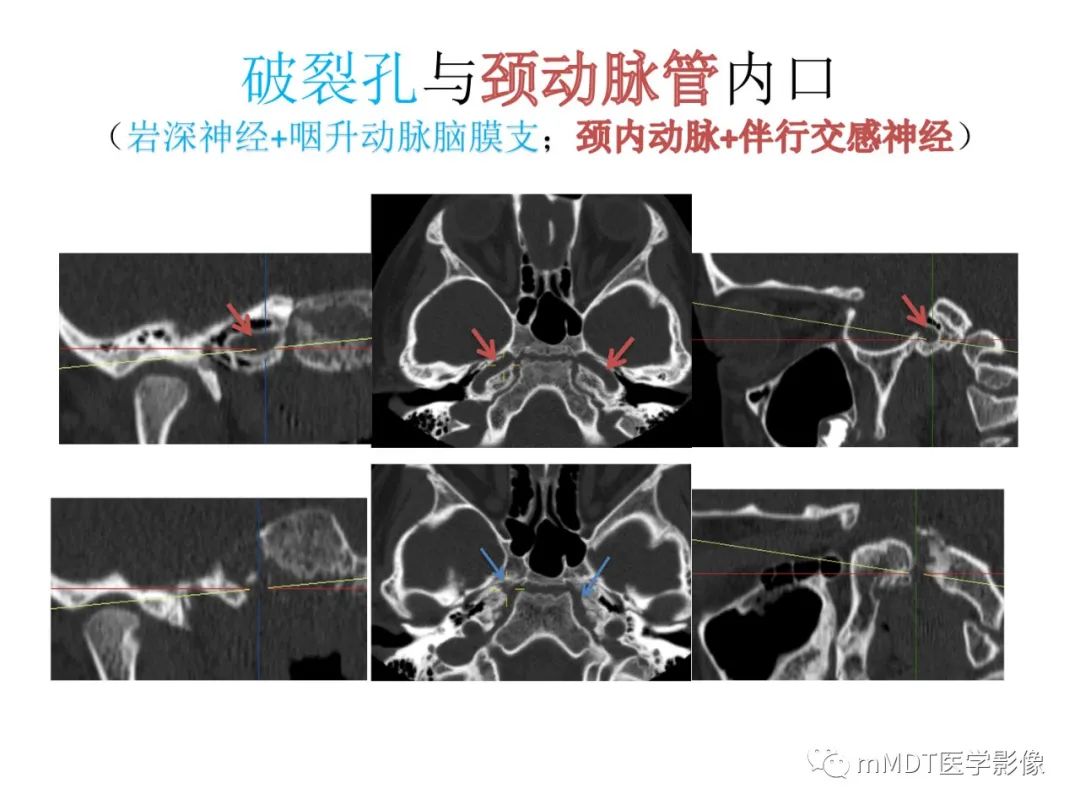 影像PPT - 【病例】岩洞深处藏神仙—穿行在颞骨岩部的神经们-110