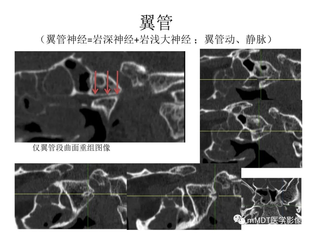 影像PPT - 【病例】岩洞深处藏神仙—穿行在颞骨岩部的神经们-113