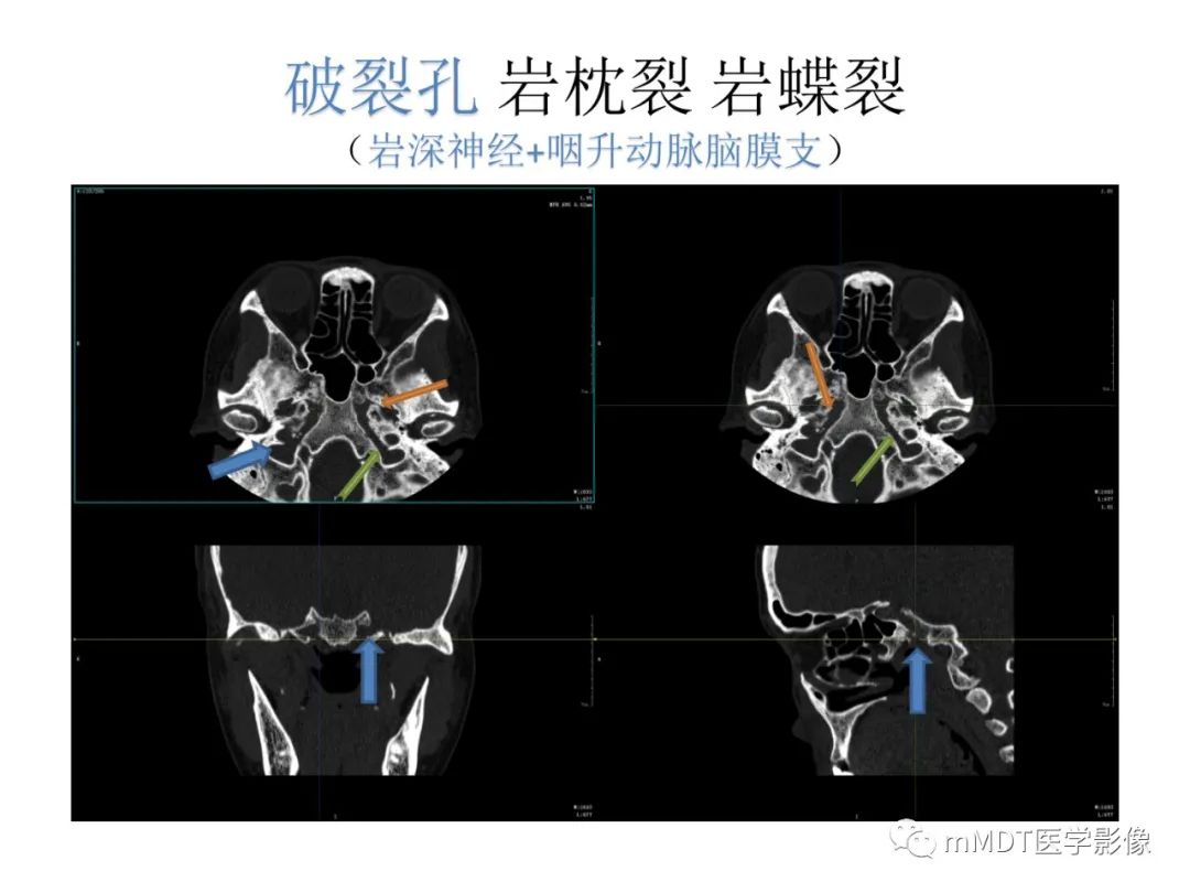 影像PPT - 【病例】岩洞深处藏神仙—穿行在颞骨岩部的神经们-111