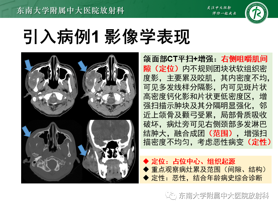 影像PPT - 【PPT】颌面部横纹肌肉瘤-2
